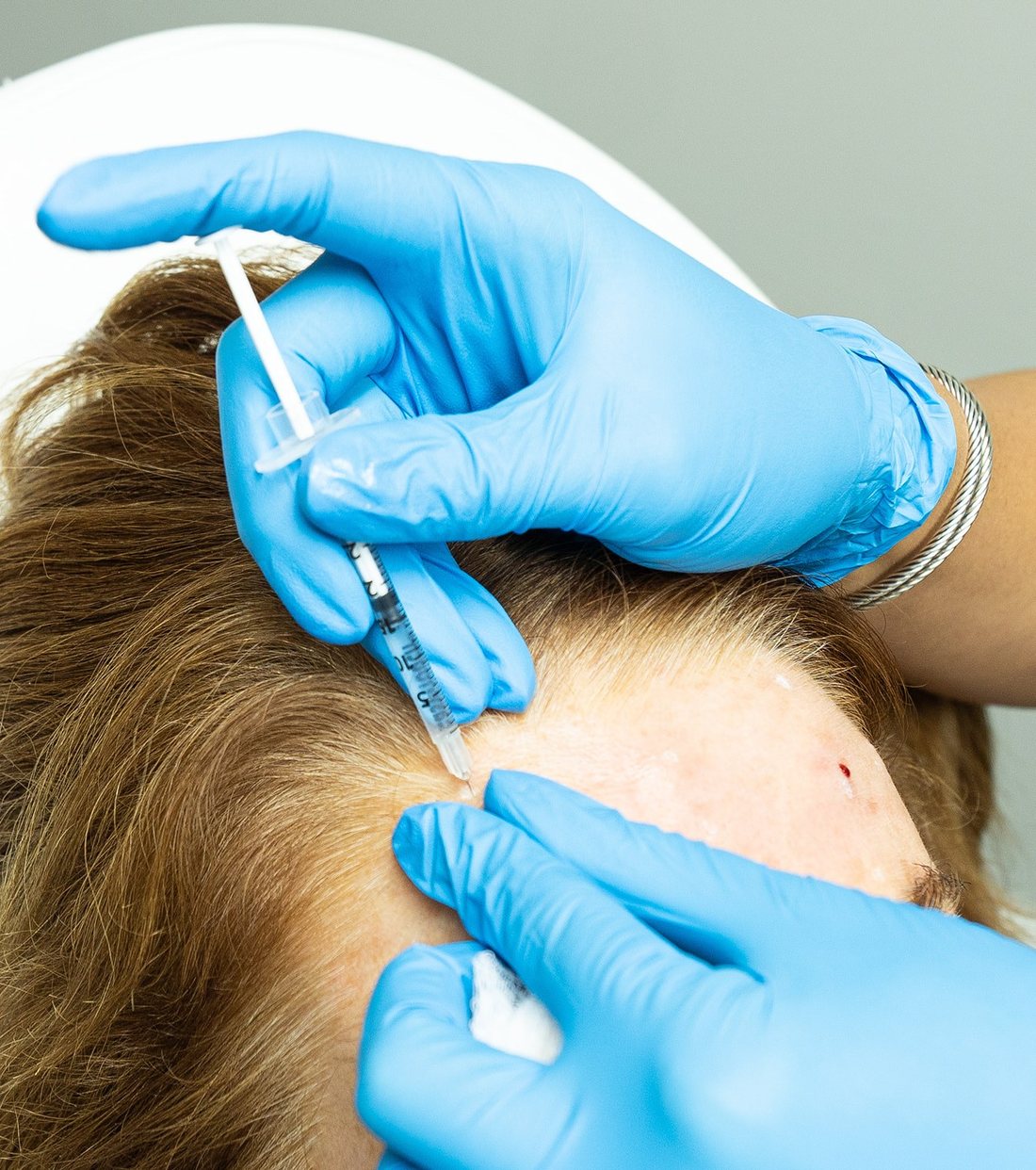 Gloved hands administer a scalp injection